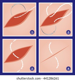 Surgery Suture Precision Point Cutting Edge Double Needle Technique in Four Stages - Needle Thread Suture Incision Flesh Skin Close to real Colors - Infographic Gradient Style