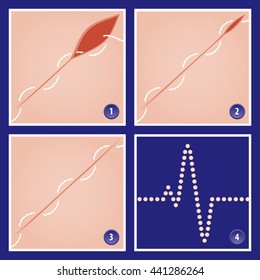 Surgery Suture Straight Cutting Edge Needle Technique in Three Stages - Needle Thread Suture Incision Flesh Skin Close to real Colors - Infographic Gradient Style