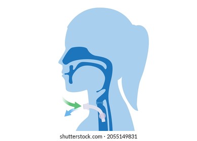 Surgical to inserted a siliconized tube into the Woman's neck and trachea to help breathe. Illustration about Medical to help a patient who can not breathe with nose and mouth.