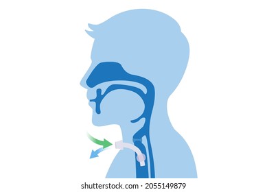 Surgical to inserted a siliconized tube into the men's neck and trachea to help breath. Illustration about Medical to help a patient who can not breathe with nose and mouth.