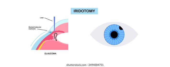 Surgical iridectomy procedure. Intraocular pressure problem. Defect of vision concept. Glaucoma, cataract and melanoma laser treatment. Surgical removal of part human eye flat vector illustration.