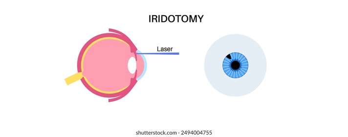 Surgical iridectomy procedure. Intraocular pressure problem. Defect of vision concept. Glaucoma, cataract and melanoma laser treatment. Surgical removal of part human eye flat vector illustration.