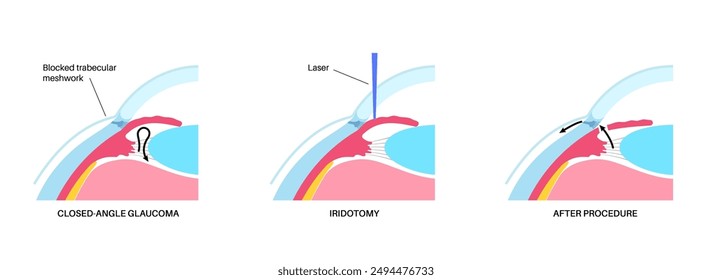 Surgical iridectomy procedure. Intraocular pressure problem. Defect of vision concept. Glaucoma, cataract and melanoma laser treatment. Surgical removal of part human eye flat vector illustration.