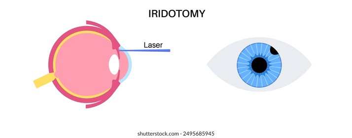 Surgical iridectomy procedure. Intraocular pressure problem. Defect of vision concept. Glaucoma, cataract and melanoma laser treatment. Surgical removal of part human eye flat vector illustration.