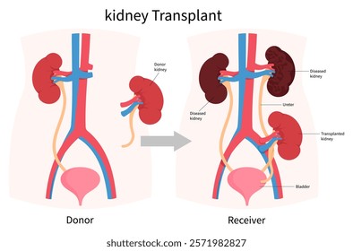 Surgical procedure for kidney transplant between donor and recipient the anatomy in medical