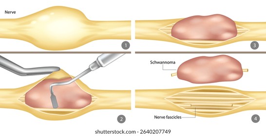 Surgical Removal of Schwannoma from Peripheral Nerve. Step-by-Step Illustration of Schwannoma Excision. Medical Diagram of Nerve Tumor Resection