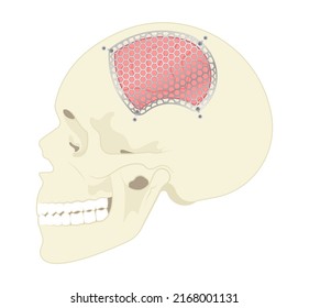 Surgical To Repair The Skull Bone With The Metal Mesh The Procedure In Medical