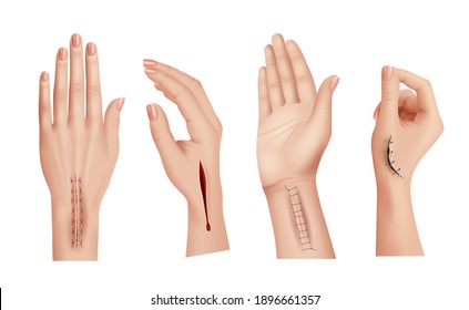 Surgical stitches on hands. Closeup scars and wounds on human hand medical damaged skin decent vector realistic templates