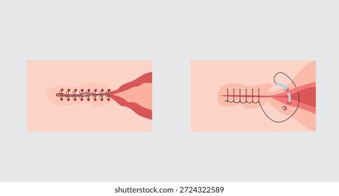 Patrones de puntadas quirúrgicas arte. Métodos de costura y Formas claramente hechas. Proceso de costura quirúrgica de tejidos y piel. Ilustración vectorial plana.eps