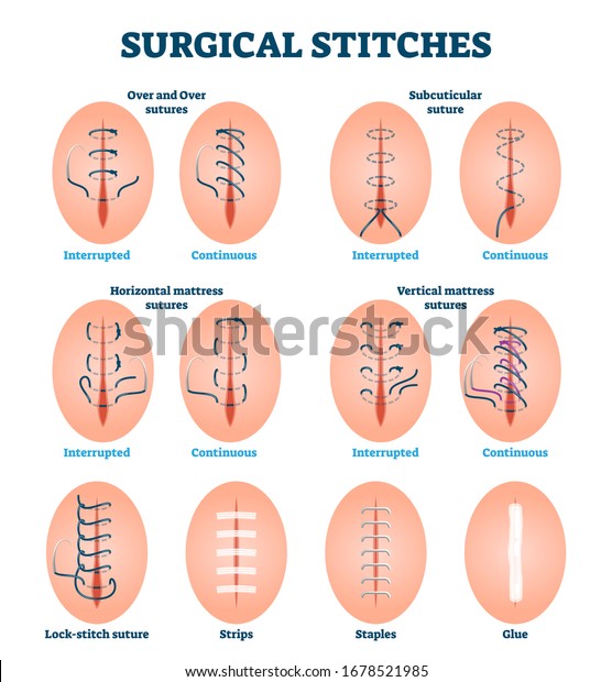 Surgical Stitches Vector Illustration Labeled Cut Stockvector 