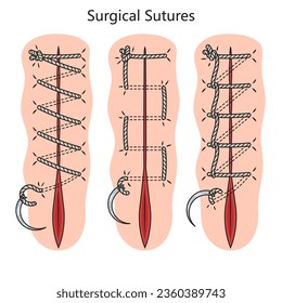 Surgical suture diagram schematic vector illustration. Medical science educational illustration