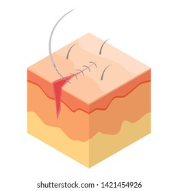 Icono de sutura quirúrgica. Isométrico del icono del vector de sutura quirúrgica para el diseño web aislado en fondo blanco