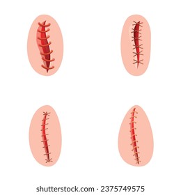 Die Symbole der chirurgischen Nähte setzen Cartoon-Vektorgrafik. Verschiedene Arten von Betriebsnähte. Chirurgie, Gesundheitskonzept