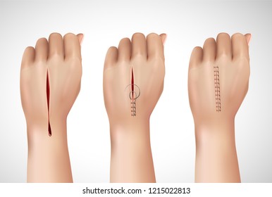 Surgical suture stitches realistic composition with isolated images of human hand at different stages of stitching vector illustration