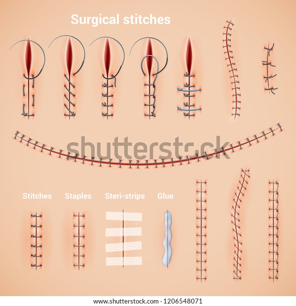 Surgical suture stitches realistic set of\
stitching methods and shapes with staples glue and text captions\
vector illustration