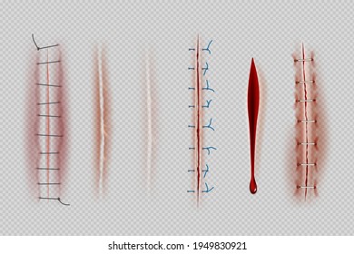 Surgical sutures. Medical closeup stitches scars and wounds decent vector realistic illustrations