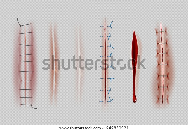 Surgical sutures. Medical closeup\
stitches scars and wounds decent vector realistic\
illustrations