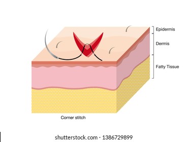 Surgical Suturing Techniques, Suturing Techniques, Corner stitch