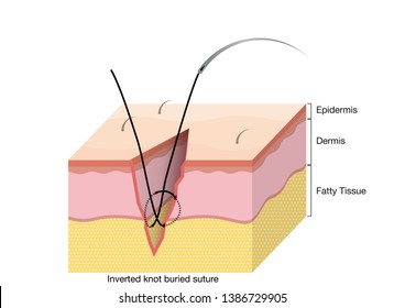 Surgical Suturing Techniques, Suturing Techniques, Inverted knot buried suture