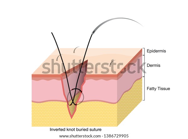 Surgical Suturing Techniques Suturing Techniques Inverted: เวกเตอร์ ...