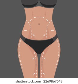 Surgical white lines on the female body, for perfect body slimming weight loss liposuction.