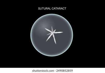 Sutural cataract disease, eye and pupil anatomy. Lens clouding, vision impairment, and potential blindness. Vision problems during aging. Human vision loss concept. Blindness 3D vector illustration