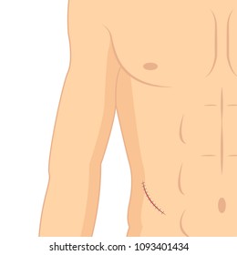 suture cartoon vector. body vector. free space for text. wallpaper. background.
Appendectomy.