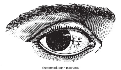 Suture of the conjunctiva after excision of pterygium, vintage engraved illustration. Usual Medicine Dictionary by Dr Labarthe - 1885.