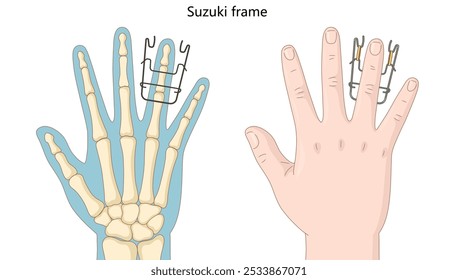 Quadro de Suzuki aplicado a dedo para estabilização de fratura, ao lado de uma visão de raio-x do diagrama de estrutura esquelética desenhado à mão ilustração vetorial esquemático. Ilustração educacional de ciências médicas