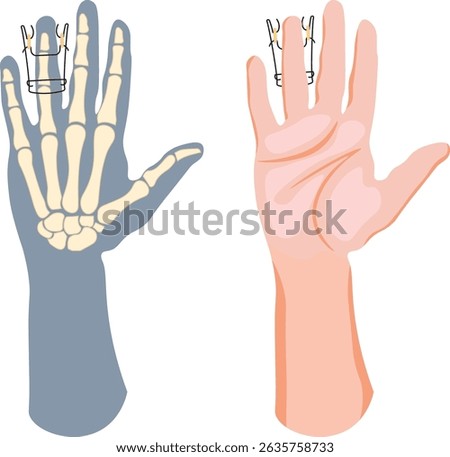 The Suzuki frame is an external fixation device used in the treatment of complex finger injuries, particularly intra-articular fractures of the proximal interphalangeal  joint.