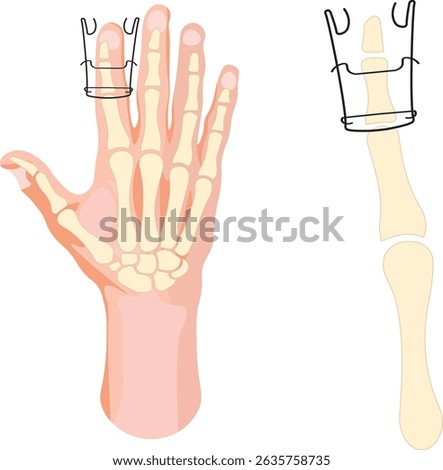 The Suzuki frame is an external fixation device used in the treatment of complex finger injuries, particularly intra-articular fractures of the proximal interphalangeal  joint.