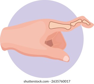 Swan neck deformity is a hand condition characterized by hyperextension of the proximal interphalangeal joint and flexion of the distal interphalangeal joint of the fingers.