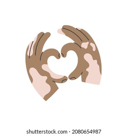 Swarthy hands with vitiligo make a heart shape gesture