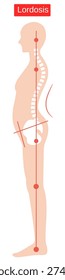 swayback human body. Shape of backbone and hipbone. health care concept