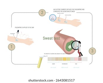 Procedimento de teste do suor envolvendo aplicação de pilocarpina, estimulação da corrente elétrica para secreção de suor e medição do nível de cloretos para diagnóstico de fibrose cística