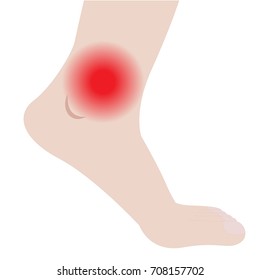 Swelling of the feet and ankles from infected or injury vector illustration