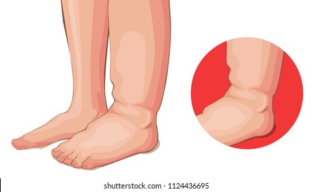 Swelling Feet Or Kidney Problems Medical Vector Cartoon