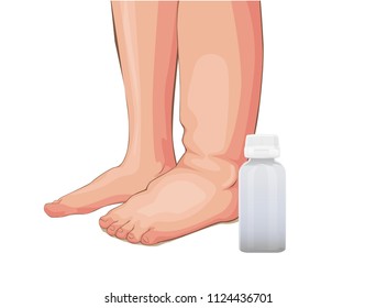 Swelling of the feet or kidney problems, medical vector cartoon