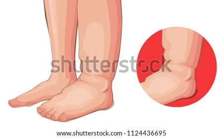 Swelling feet or kidney problems medical vector cartoon Foto d'archivio © 