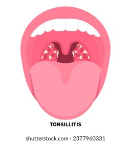 swelling of tonsil gland that cause by bacterial infection with medical examination