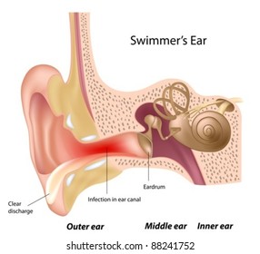 Swimmer's ear