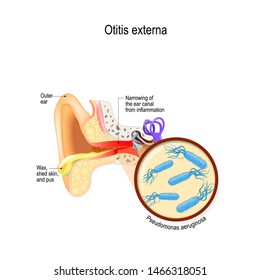 Swimmer's ear. Otitis externa is inflammation of the ear canal. bacterial infections disease. Close up of  Pseudomonas aeruginosa. Human anatomy. illustration for medical use