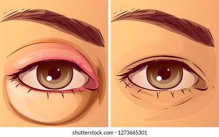 Swollen eye, before-after. Vector illustration.