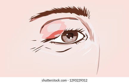 Swollen eyelid occurs when there is inflammation or excess fluid in the connective tissues surrounding the eye. Swollen eyes can be painful and non-painful, and affect both the upper and lower eyelids