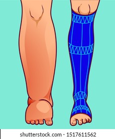 Swollen feet, before-after. Foot in protective sock. Vector illustration