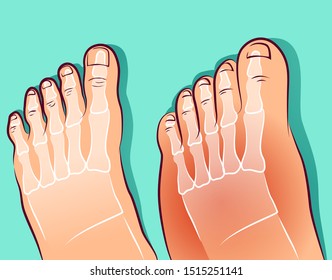 Swollen feet, before-after. Vector illustration