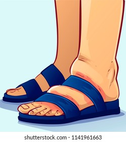 Swollen feet, vector illustration