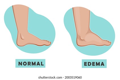 A Swollen Foot And Ankle And A Normal Foot. Edema. Vector Illustration Of The Disease