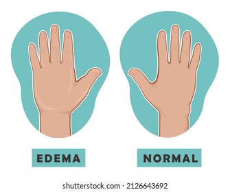 Swollen hand and normal hand. Edema and lymphedema. Vector illustration of the disease before-after. svg