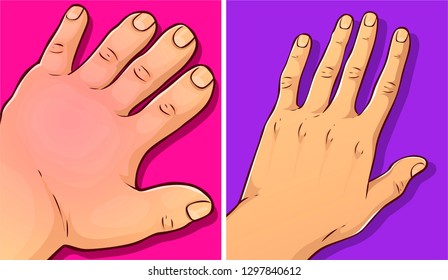 Swollen hands, before-after. Vector illustration